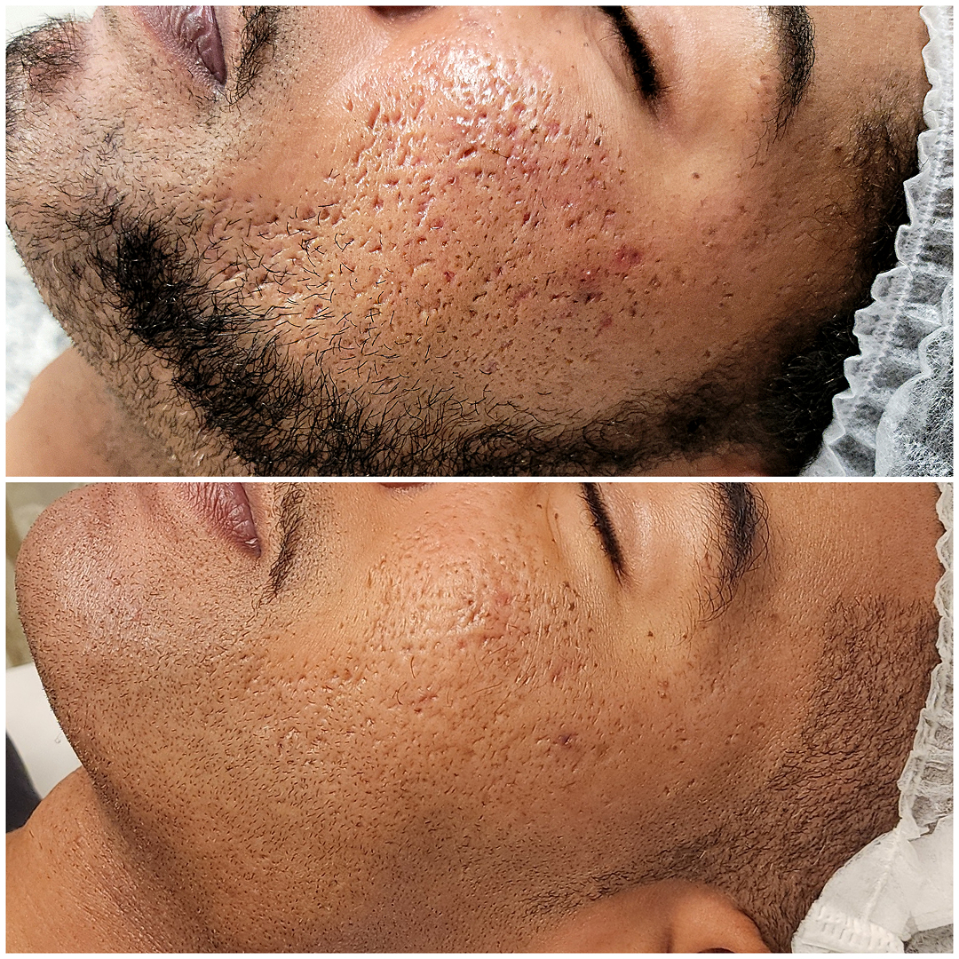 Ice Pick Acne Scars New York City,  USA