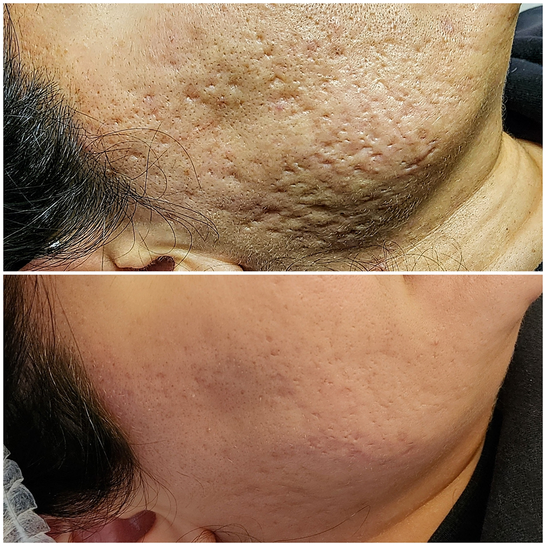 Deep Acne Scars New York City,  USA