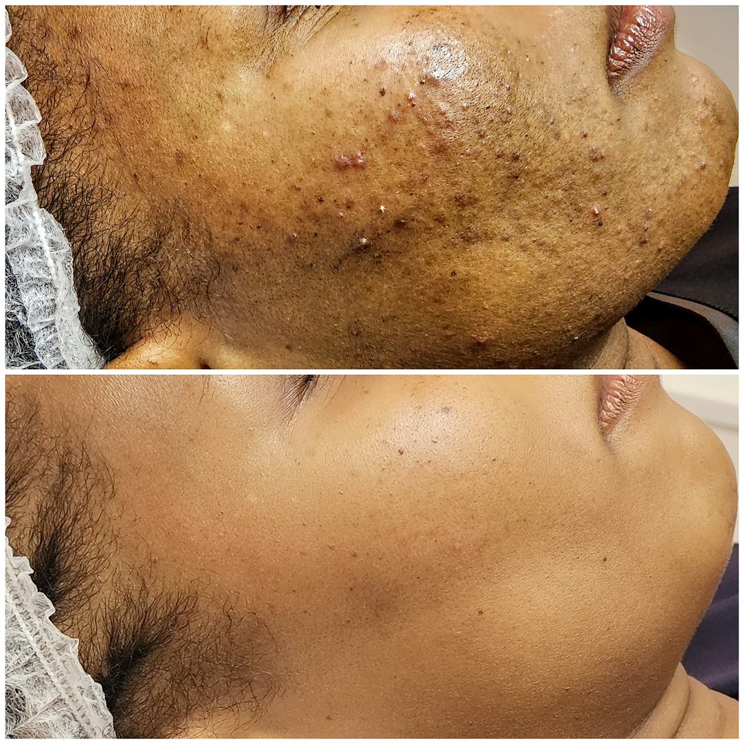 Hyperpigmentation Acne Scars New York City,  USA
