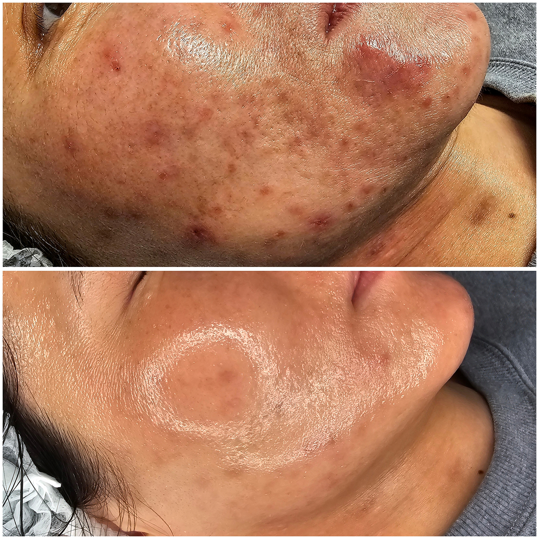 Red Acne Scars New York City,  USA