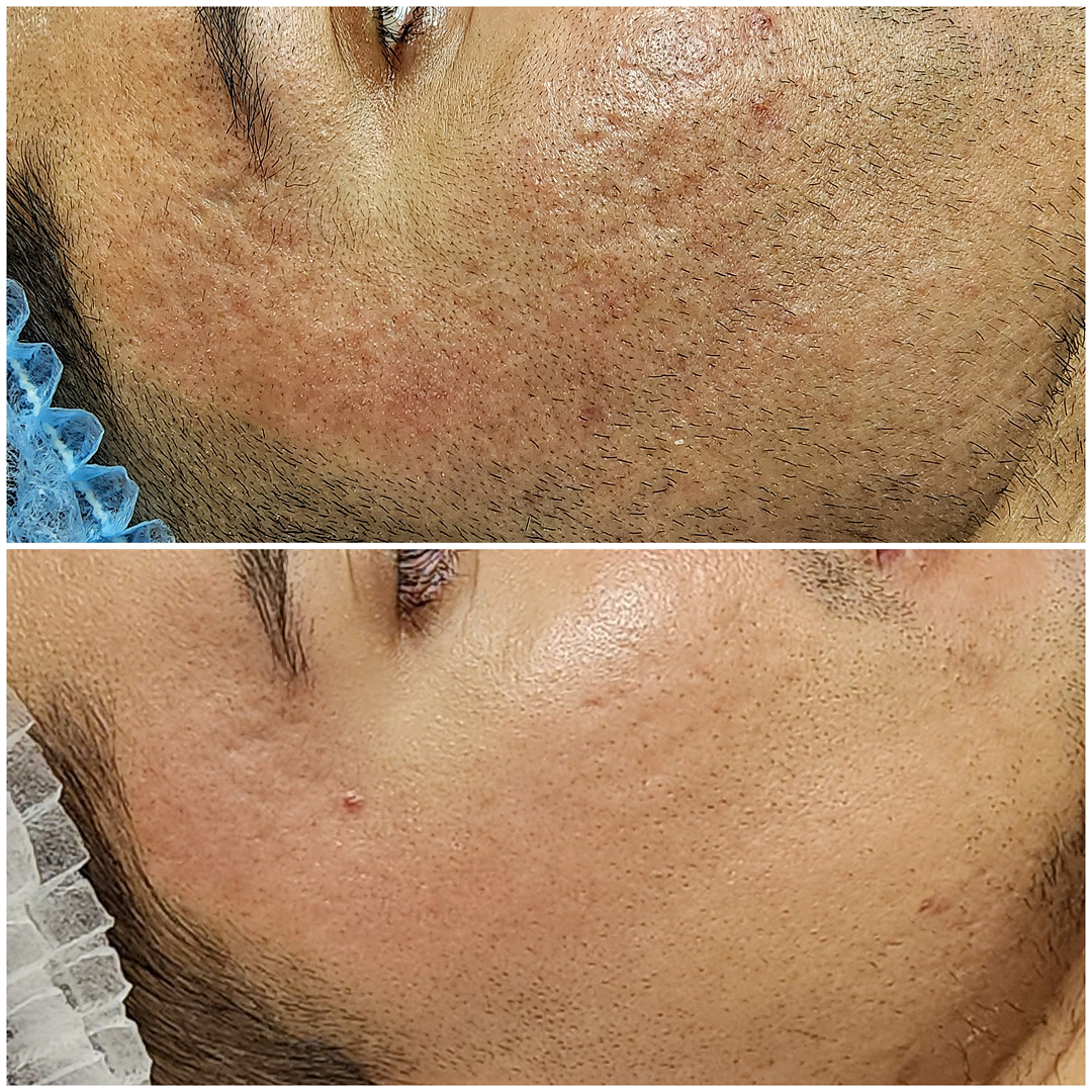 Red Rolling Acne Scars New York City,  USA
