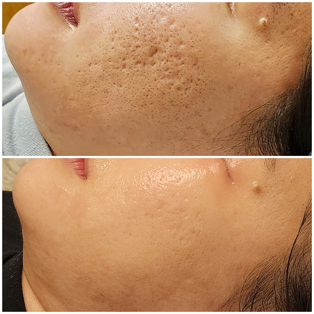 Deep Ice Pick Acne Scars New York City,  USA